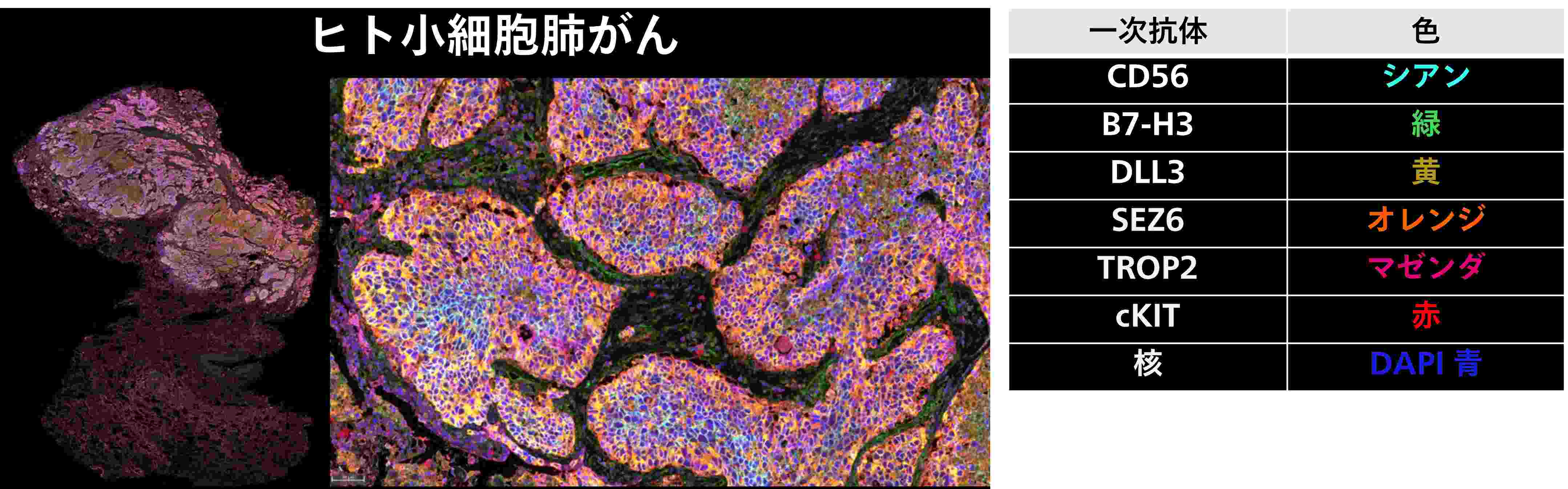 ヒト小細胞肺がん
