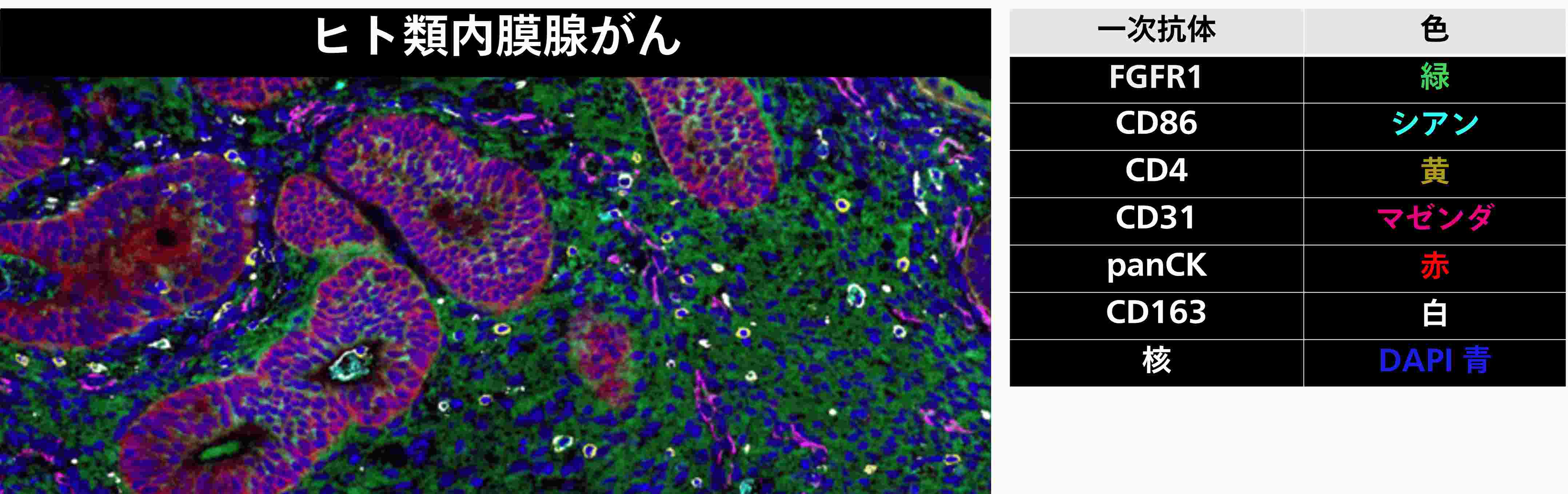 ヒト類内膜腺がん
