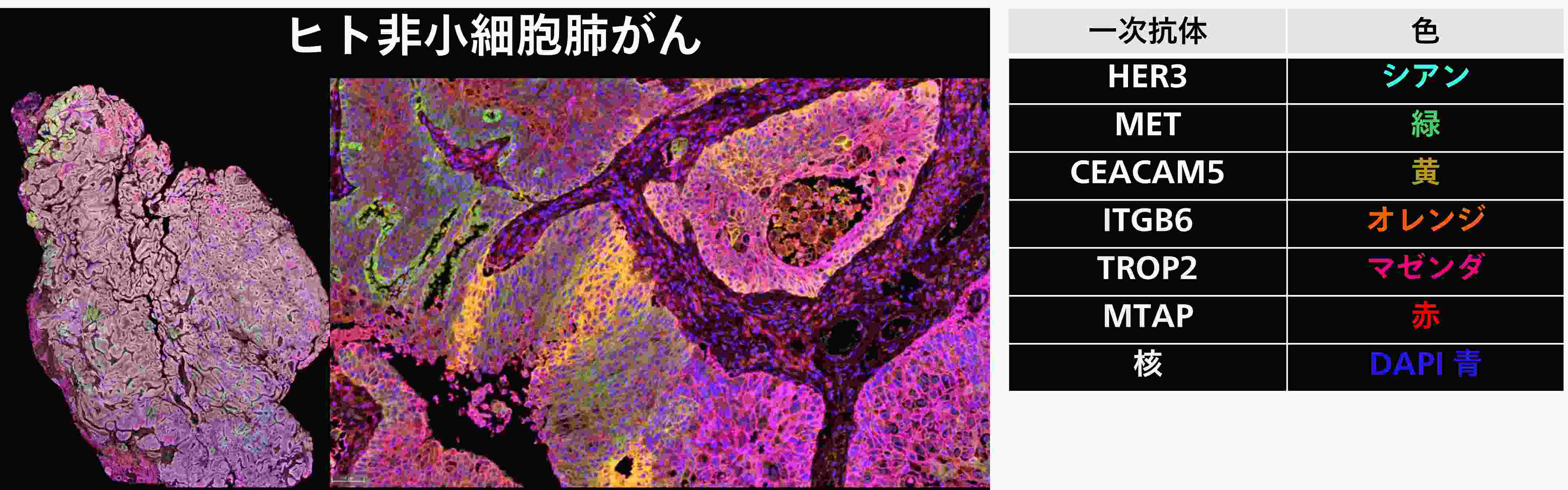 ヒト非小細胞肺がん