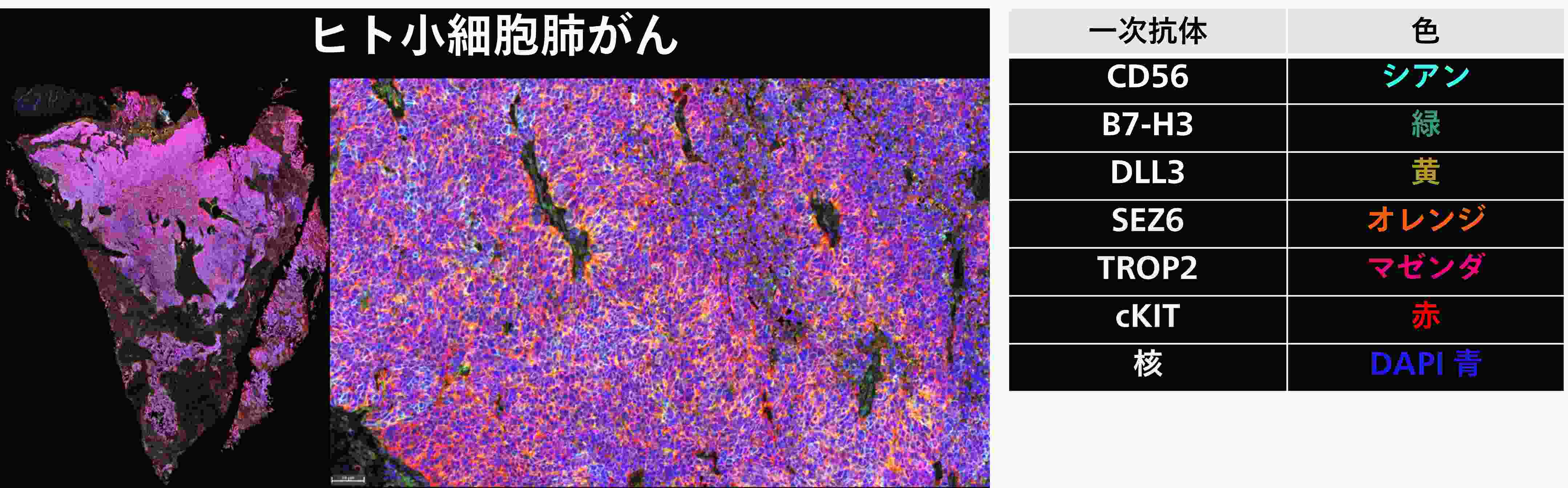 ヒト小細胞肺がん
