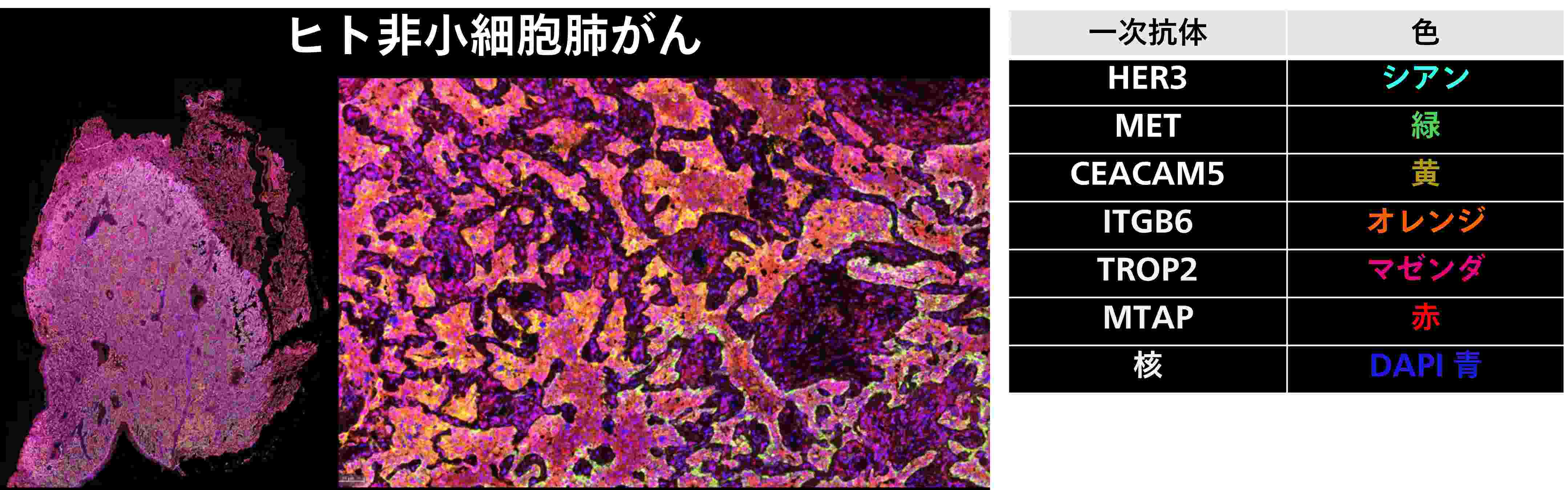 ヒト非小細胞肺がん