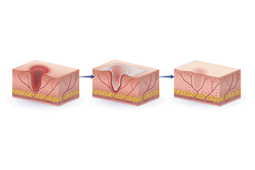 Illustration showing three stages of skin healing: an initial deep wound in the skin, a partially closed wound with new tissue forming, and a fully healed surface, with arrows indicating progression from injury to recovery.