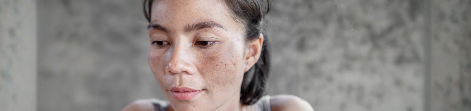 Troubles pigmentaires